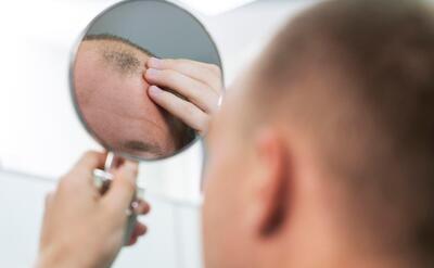 Adult male having balding problems